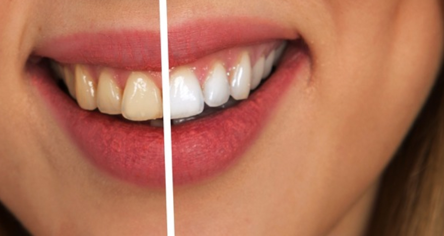 loveteeth-before-and-after